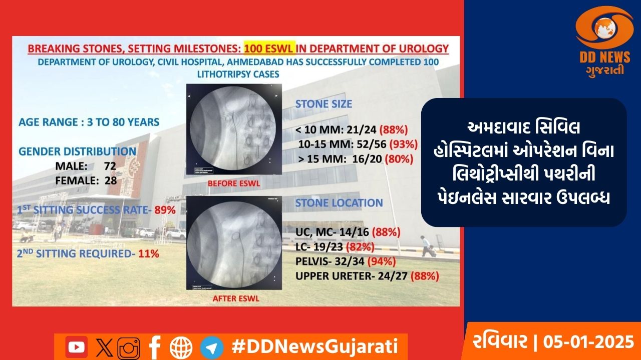 લિથોટ્રીપ્સી દ્વારા ૧૦૦ દર્દીઓની પથરીને કોઈ પણ કાપા વિના દૂર કરાઈ